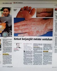 Clipping: Ketuat berjangkit melalui sentuhan