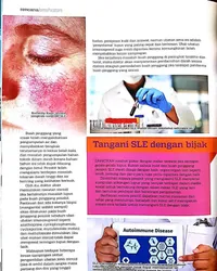 Clipping: Tangani SLE dengan bijak